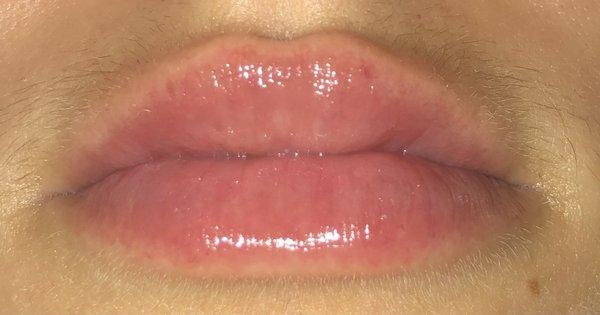 After lip filler - healed. (Don't mind the peach fuzz.)