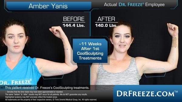 Amber took advantage of Dr. Freeze's employee transformation program and made her arms slimmer with CoolSculpting.