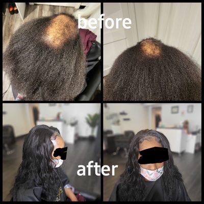 Client received a follicle revitalizer treatment and lace installation