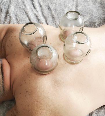 Fire cupping