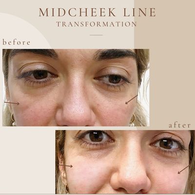 Mid-cheek Line Before & After