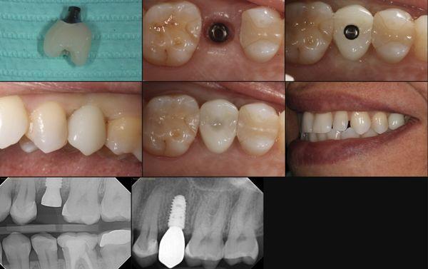 A perfectly centered and healthy dental implant done completely at our office.