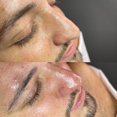 #mensfacial #facial #hydrodermabrasion