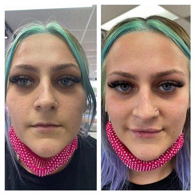 Lips Fillers before and after