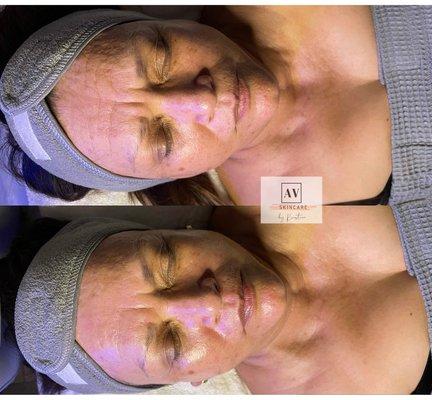 Before and Immediately After The Works HydraFacial with Dermabuilder