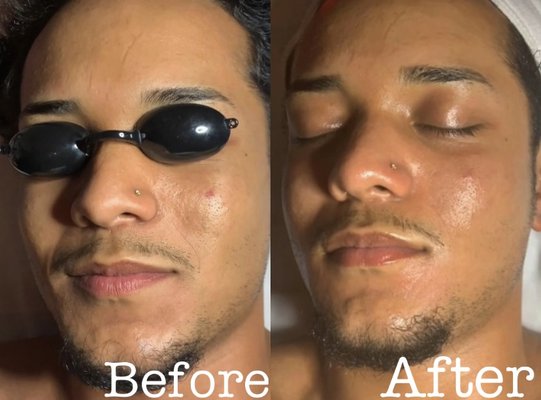 gentlemen's microdermabrasion facial.