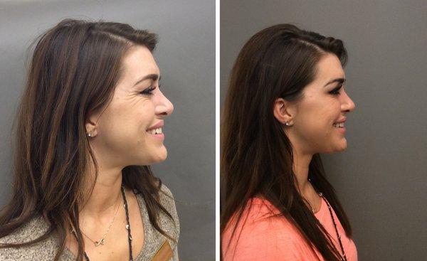 Botox for crows feet correction