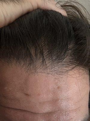 Crown hairline thinning from pill pushing predatory TRT business practices.