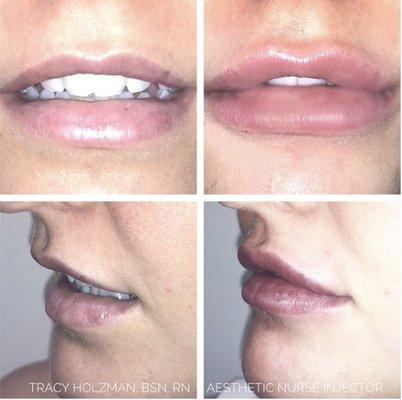 Beautiful yet subtle, natural-look lips.   1cc (total) of Revanesse Versa injected into the philtral columns, Cupid's bow.