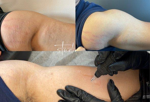 Red Stretch Mark Treatment