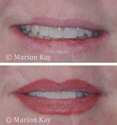 Before & healed lip blend