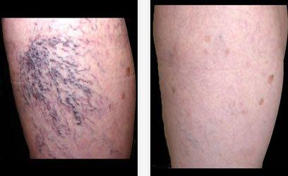 Sclerotherapy(spider vein treatment) with laser or Asclera injection