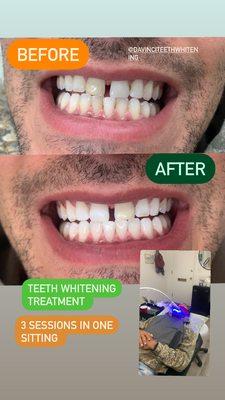 Teeth whitening