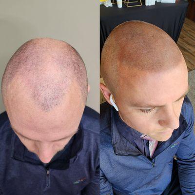 Scalp Micropigmentation solution for baldness