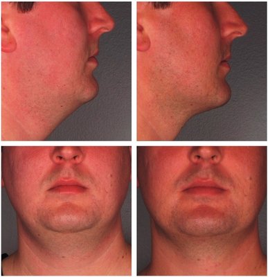 Kybella Fat Reduction Under Chin