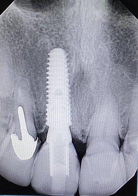 Implant to restore missing tooth