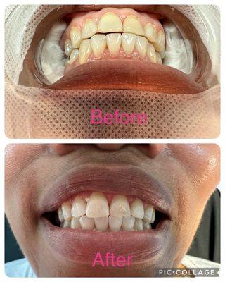 Teeth Whitening