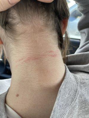 Cuts on neck