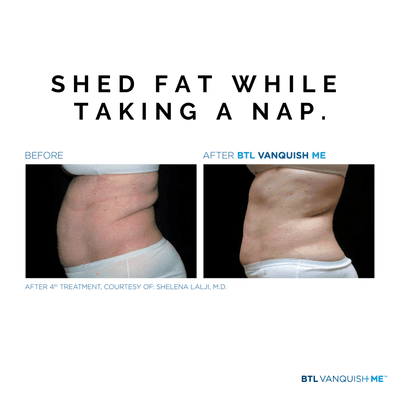 No joke! This fat reduction service is 45 minutes of pain free relaxation. Lose inches without skipping a beat.