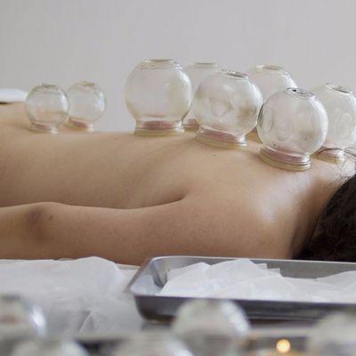 Cupping Therapy using Well-cup (Flexible Rubber Cupping)