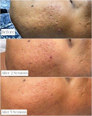 Microneedling treatments