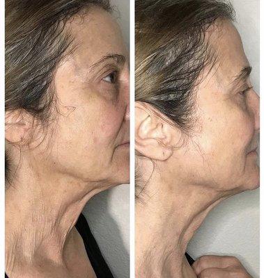 1st session of Jawline & Neck Contour