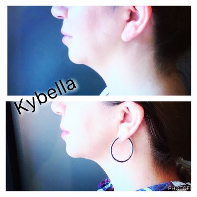 Eliminate a double chin with Kybella.