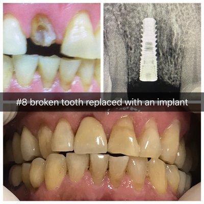 Broken Tooth, extracted, replaced with implant and Crown.