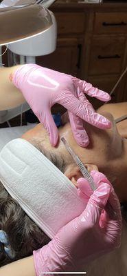 Dermaplaning