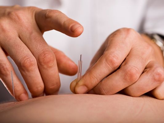 Acupuncture