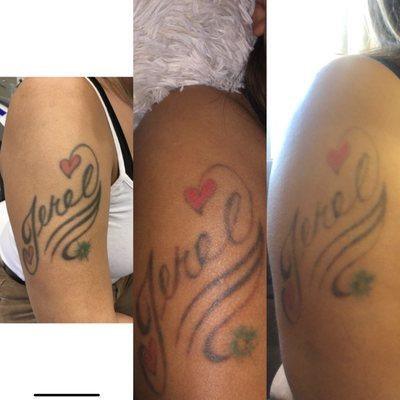 Laser tattoo removal