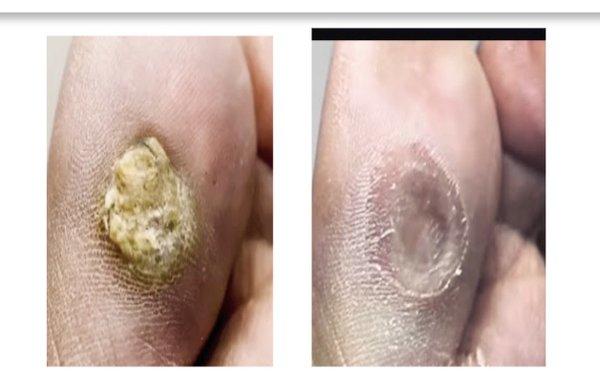 A very dried thick callus is on a big toe.   The callus is removed, but will grow back if the pressure is not shifted.