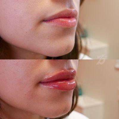 Before & After 
Service: The Mini
Product: 0.5 mL of Restylane Kysse lip filler