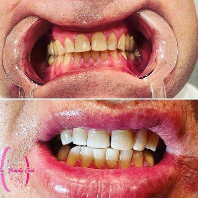 Amazing results after 1 hr of teeth whitening treatment