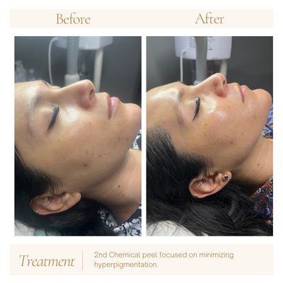 Chemical Peel Treatments are an excellent way to assist with dark spot correcting, fine lines & wrinkles, acne scarring & overall even tone.