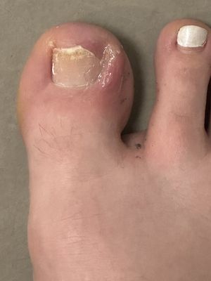 Toenail after doctor