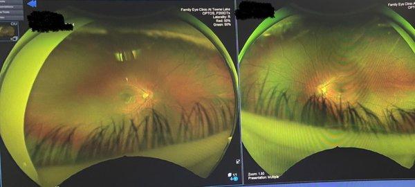 Imaging that allows in-depth view to the back of the eye. No need for dilation