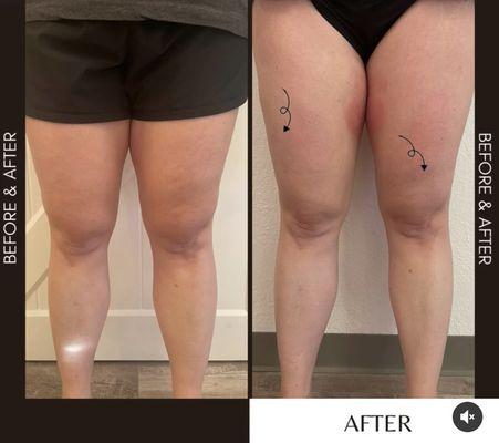 Cryoskin slimming on upper & inner thighs