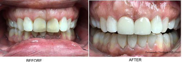 one of the many cases , before and after of two front teeth.