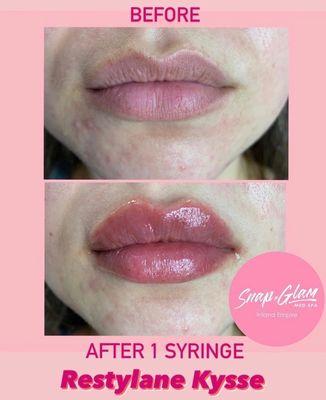 Lip filler before / after Restylane