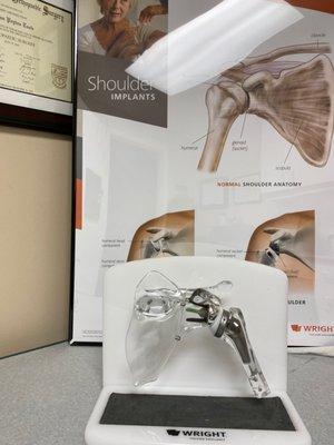 A model of a shoulder replacement and a poster which is used in clinic by Dr. Toole to help patients better understand shoulder surgery.