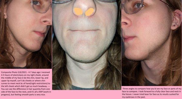 Composite of what hair removal and non-removed hair looks like. You will eventually be hair free, but it takes time.