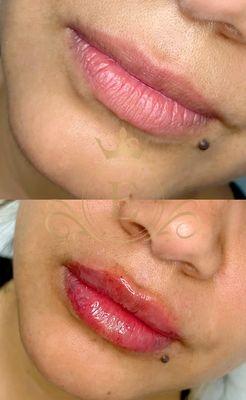 Stunning lip enhancement with Revanesse Lips+