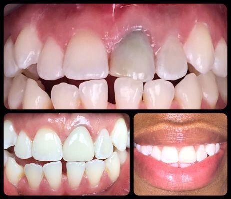 Another case of a tooth darkening over time due to trauma or root canal treatment. Simple cosmetic treatment can make a big difference!