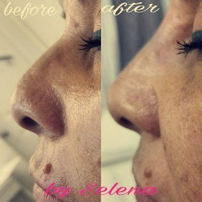 NSNJ ..Non surgical nose job