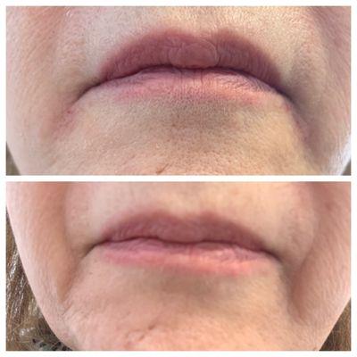 Correction of sagging lips ( Marionette lines)!