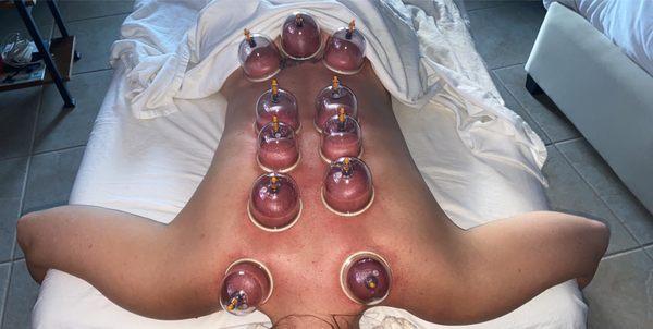 Stationary Cupping