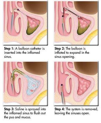 For qualified patients Dr. Rosenbloom is happy to offer in-office balloon sinuplasty as an alternative to a procedure in the OR.