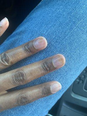 Nail infection, unhealthy practices