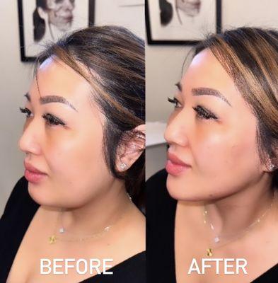 8 point non-surgical face lift with fillers